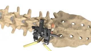 MAS TLIF  Patient Animation [upl. by Philbrook]