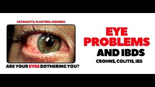 Eye problems with IBDs Crohns Disease and Ulcerative Colitis [upl. by Verile]