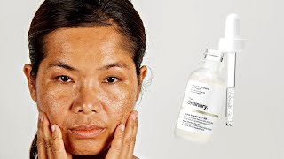 How To Use The Ordinary Alpha Arbutin 2  HA for Hyperpigmentation [upl. by Nanahs336]