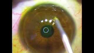 PRK NORMALIZATION WAVEFRONT GUIDED  ACELERATED quotHIGHFLUENCEquot AVEDRO CORNEAL CROSSLINKING KXL [upl. by Krischer]