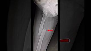 x raythigh ap lat fracture vairalvideo anatomy radiological shorysvideo [upl. by Elwood]