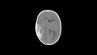 Types of Brain Herniations  Shorts [upl. by Basso]