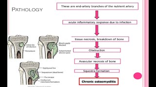 chronic osteomyelitis [upl. by Raye]