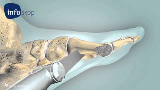 3D medical animation  Osteotomy  Hallux Valgus  designidentity [upl. by Atauqal]