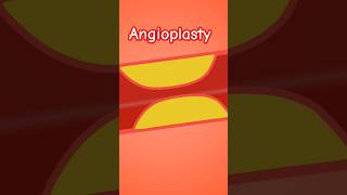 😱😱 Angioplasty surgery by cardiologist surgeon  song love music nursing doctor medical [upl. by Ttik]