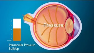 The mechanisms of optic nerve damage [upl. by Nonnek]