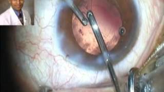 Topical Phaco amp Acridiff Multifocal IOL Implantation Dr Suresh K Pandey Kota India [upl. by Ayotnahs]