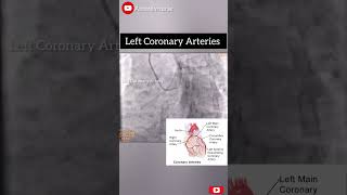 A coronary angiogram cathlab angiogram assessment coronaryarterydisease coronary [upl. by Arateehc]