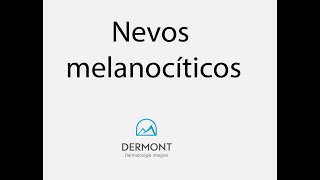 Nevos melanocíticos [upl. by Nabatse]