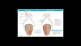 umn vs lmn 7th nerve palsy [upl. by Raman]