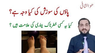 paon ki sujan ka ilaj in urdu  swelling on foot  پاؤں کی سوجن کا علاج [upl. by Ecenahs]