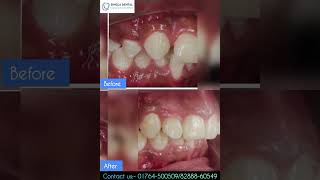 Braces before amp after ytshort orthodontist trendingshorts [upl. by Yknip]