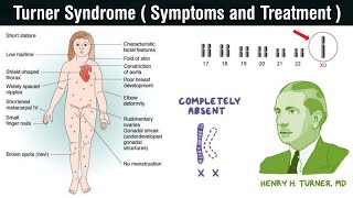 Turner Syndrome  monosomic disorder  symptoms and treatment of turner syndrome in Hindi [upl. by Yasdnyl917]