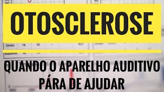 OTOSCLEROSE quando o aparelho auditivo para de funcionar  Dr Luciano Moreira OTORRINO [upl. by Olodort]