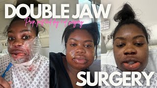 What its REALLY like having double jaw surgery  VLOG [upl. by Demeter]