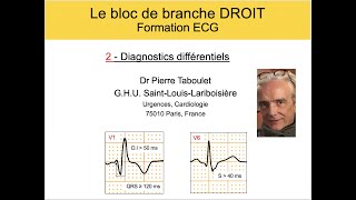 4f Bloc de branche droit 2 Diagnostics différentiels ECG Dr Taboulet [upl. by Light]