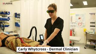 KLaser Blue Derma  Treatment brown spots on legs  Carly Whytcross [upl. by Martres171]