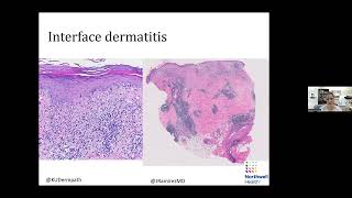 Global Dermatology Talks 11272023  Silvija Gottesman [upl. by Haimorej]