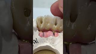 Two implants with 4 unit Hygiene ceramics [upl. by Aker557]