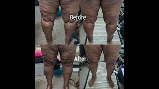 Cellulite treatment on the front amp back of legs and thighs bodysculpting cellulitetreatment [upl. by Siocnarf]