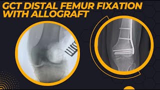 DISTAL FEMUR GCT WITH PATHOLOGICAL FRACTURE PLATING WITH ALLOGRAFT USED WITH EXCELLENT RESULT [upl. by Amethist]