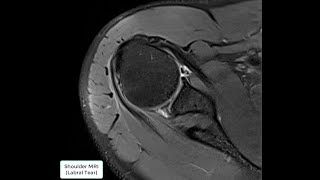 Shoulder MRI Labral Tear [upl. by Aivat767]