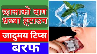 Benefits of Ice Cube for Skin Health  छालाको स्वस्थ्यको लागी बरफको महत्व [upl. by Anitram]