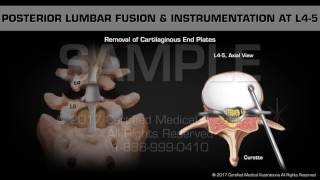 Posterior Lumbar Fusion amp Instrumentation at L45 [upl. by Etteneg]