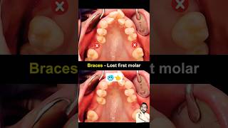 Braces when Lost first molar teeth braces orthodontist dentist dentistry [upl. by Armillas290]