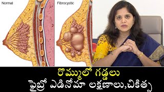 Fibroadenosis of Breast in Women Causes amp Treatmentరొమ్ములో గడ్డలు ఫైబ్రో ఎడినోమా లక్షణాలుచికిత్స [upl. by Anahcra]