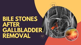 Bile Stones After Gallbladder Removal [upl. by Attaynek]