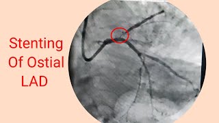 Heart attack AWMI lI Stenting of Ostial LAD [upl. by Nosylla]