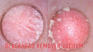 Closeup Blackhead Remover Pore Vacuum Cleaner Review Shorts [upl. by Kakalina]