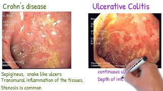 Understanding Treatment Options in IBD [upl. by Ammeg439]