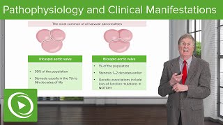 Calcific Aortic Stenosis  Pathophysiology and Clinical Manifestations [upl. by Jeanne386]