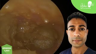 1363  Complex Treatment of Eczematous Otitis Externa [upl. by Azmuh]