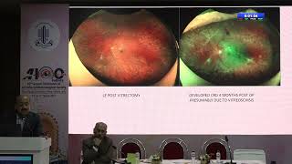 AIOC2024 GP137 Topic Dr Sharad Bhomaj Whitish yellowish veils seen on fundus examination…what am I [upl. by Winfrid]