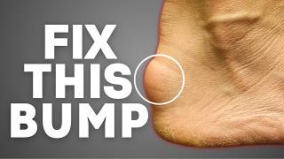 8 Haglunds Deformity Exercises to Fix Your Heel Pain [upl. by Eemla]