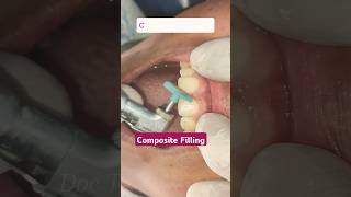 Cosmetic filling in upper front tooth  Composite Filling  Teeth filing composite dentist [upl. by Dawn]