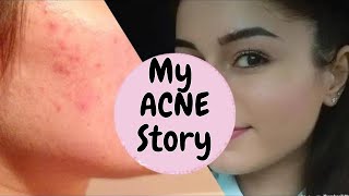 My Acne story Accutane PCOS retinoids I The Junior Doctor [upl. by Ardnajela]