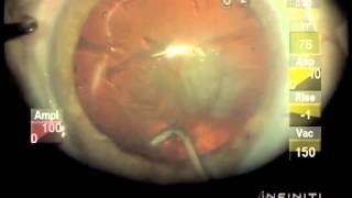 Hydrodissection and Nucleus Rotation [upl. by Ahselrak]