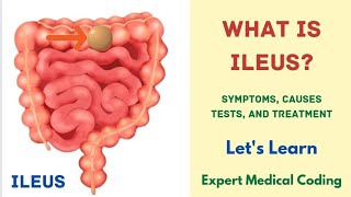 What is Ileus  Symptoms  Causes  Complications  Tests  Treatment Precautions Medical Coding [upl. by Irina373]