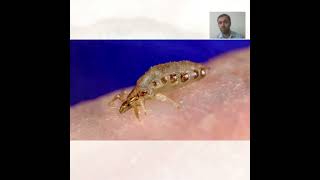 Body Lice Treatment  Symptoms and Causes  Diagnosis  Prevention health [upl. by Fradin262]