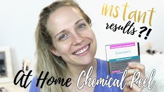 EXUVIANCE PERFORMANCE PEEL REVIEW  AT HOME CHEMICAL PEEL  Makinze [upl. by Jar]