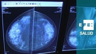 Radiología quotmilimétricaquot contra el cáncer de mama [upl. by Nnagem902]