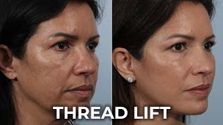 Discover the Secret to a Youthful Look The Thread Lift [upl. by Bringhurst]