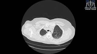 SCANNER THORACIQUE  Pleurésie bilatérale déjà traité pour TBK pulmonaire [upl. by Bracci237]