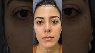 Preenchimento de lábios e olheiras harmonizacaofacial lips beleza preenchimentofacial botox [upl. by Bronder]