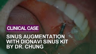 Implant placement using flapless crestal sinus approach technique [upl. by Mickey]