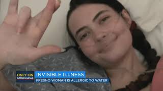 Woman with water allergy describes living with rare condition [upl. by Naux]